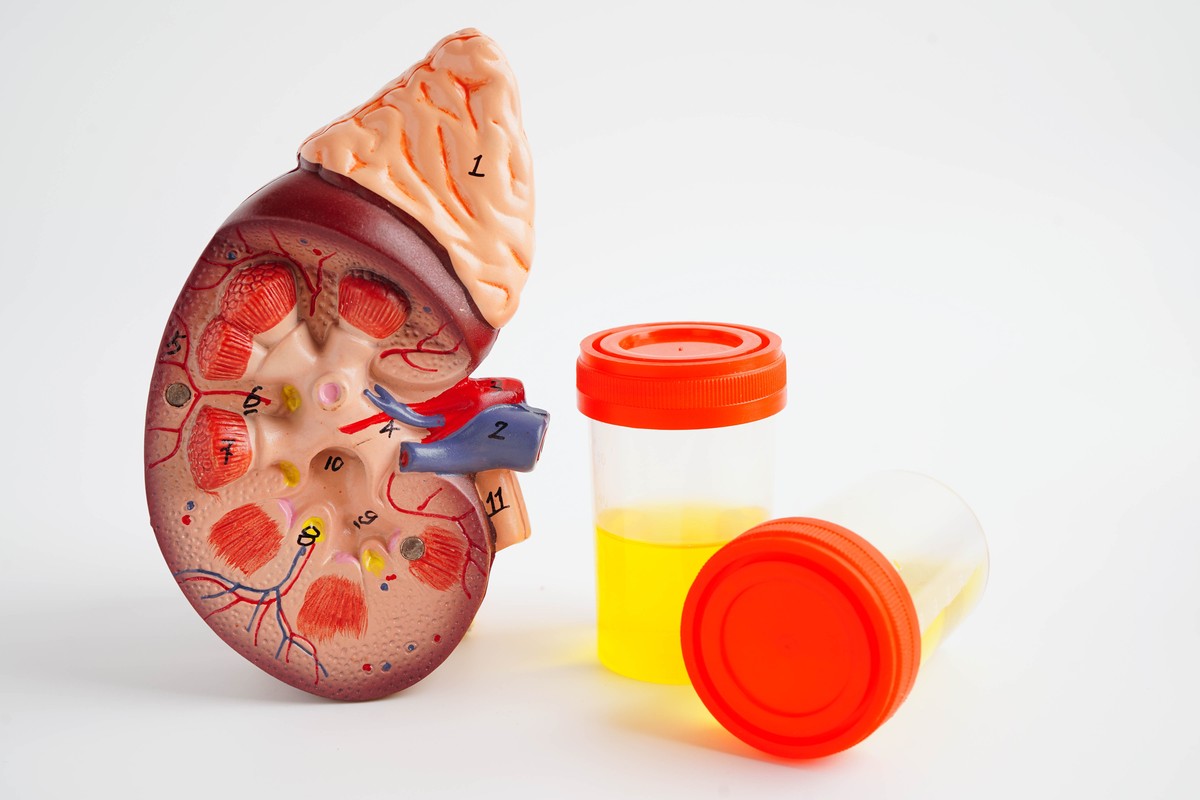 Sai lầm thường mắc phải khi phân tích kết quả xét nghiệm nước tiểu